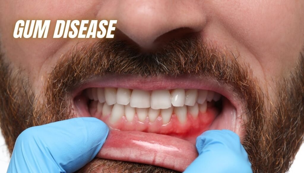 Gum Disease